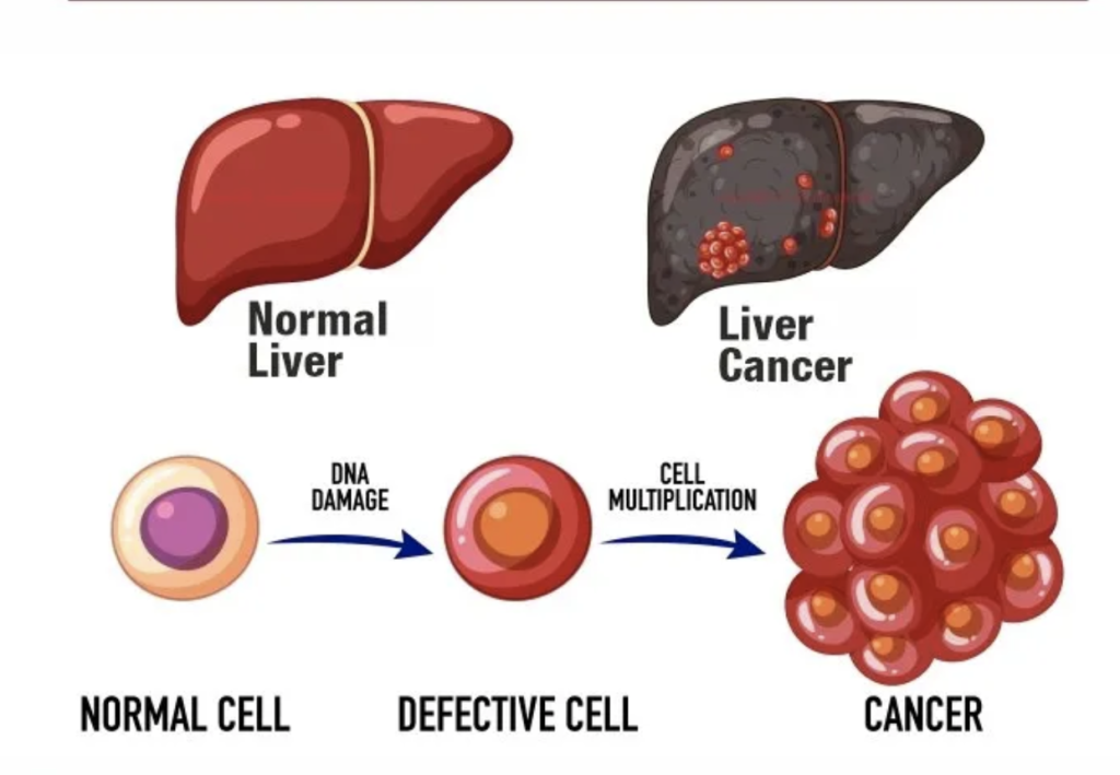 Bioresonance therapy and Liver cancer